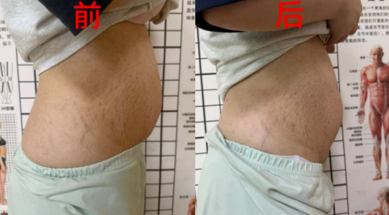 4次治疗后 4次治疗后